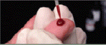 Photo series of the Capillus&trade; HIV-1/HIV-2 testing kit