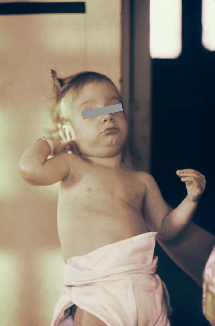 Congenital rubella syndrome infant with cataracts