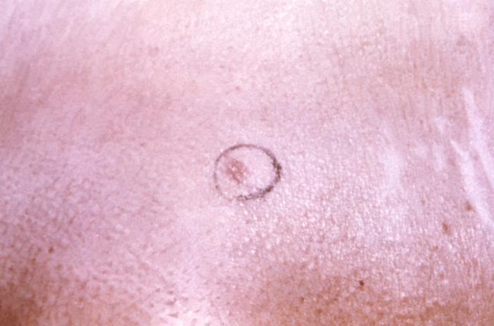 Details - Public Health Image Library(PHIL)