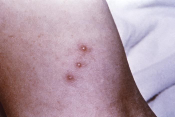 Details - Public Health Image Library(PHIL)