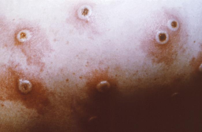 Haole Rot Details - Public Health Image Library(PHIL)