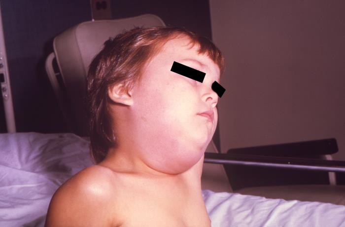 Mumps with parotid swelling