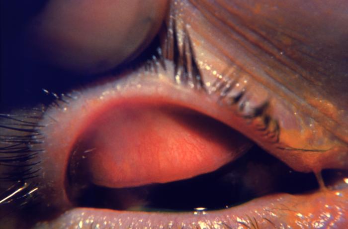 Details - Public Health Image Library(PHIL)