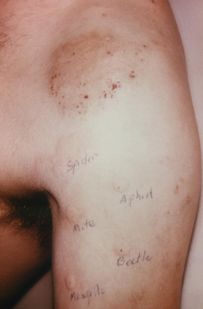 Details - Public Health Image Library(PHIL)
