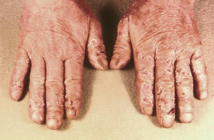 Details - Public Health Image Library(PHIL)