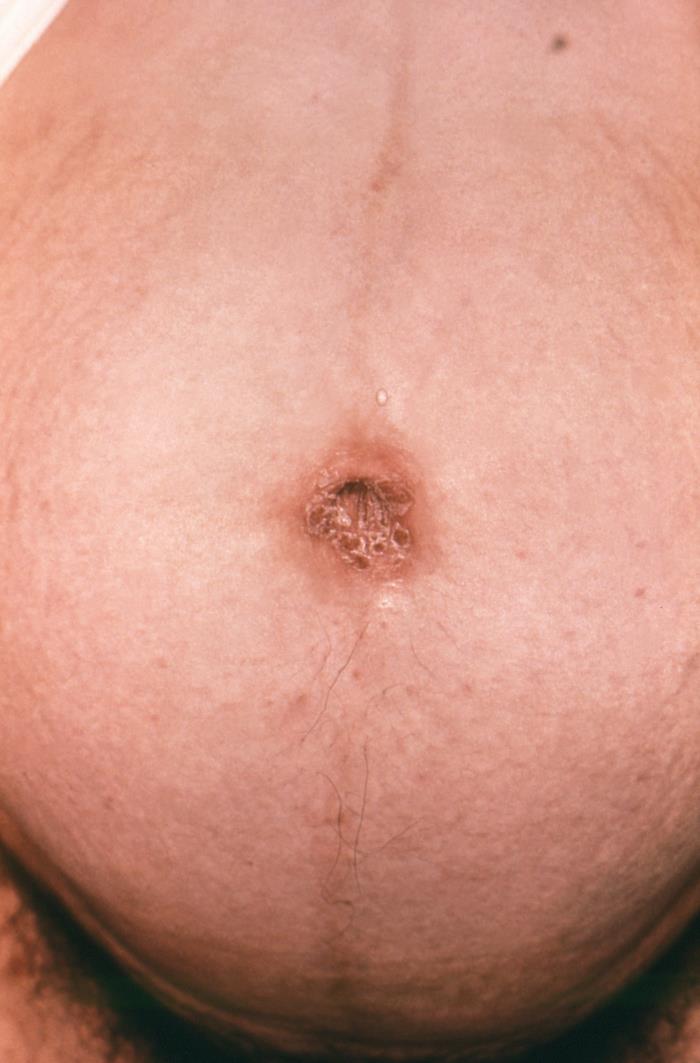 Details - Public Health Image Library(PHIL)