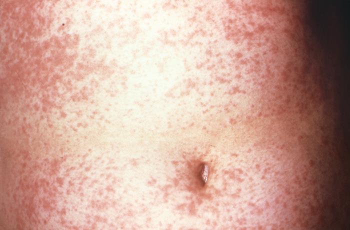 Details - Public Health Image Library(PHIL)