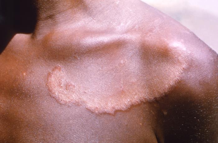 Details - Public Health Image Library(PHIL)