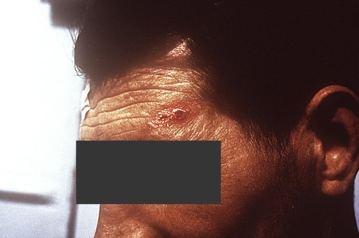 Details - Public Health Image Library(PHIL)