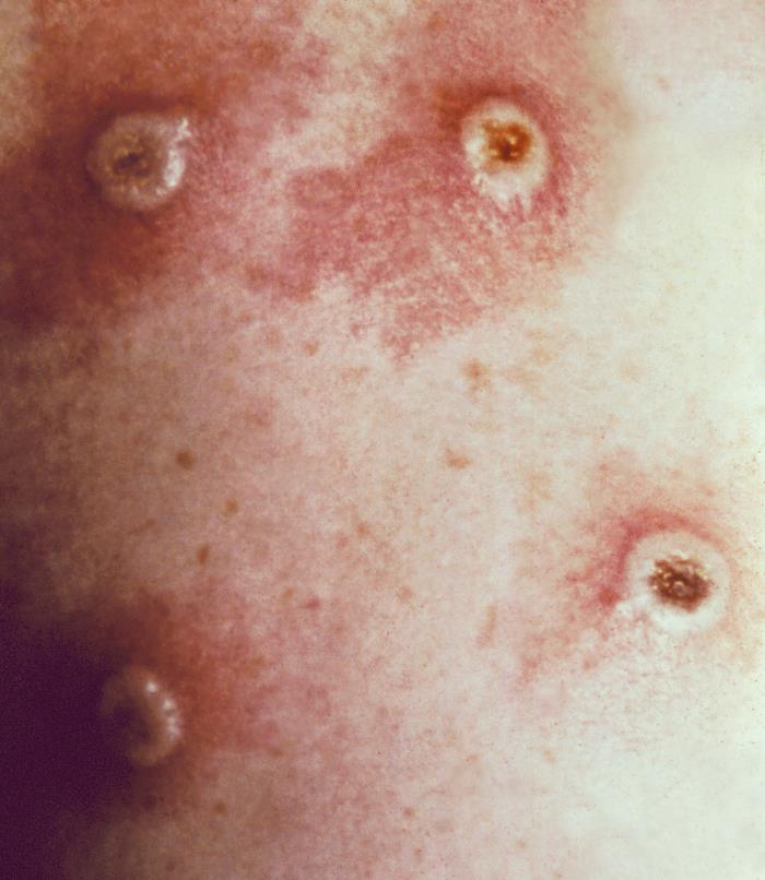 Skin Innoculation Infection Details - Public Health Image Library(PHIL)