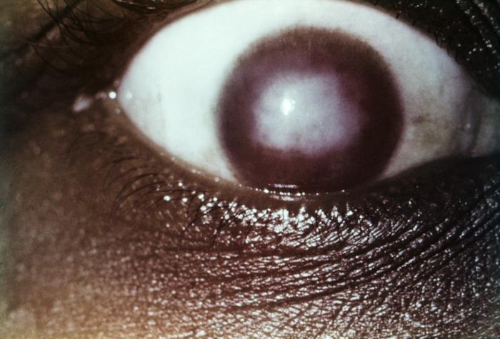 Details - Public Health Image Library(PHIL)
