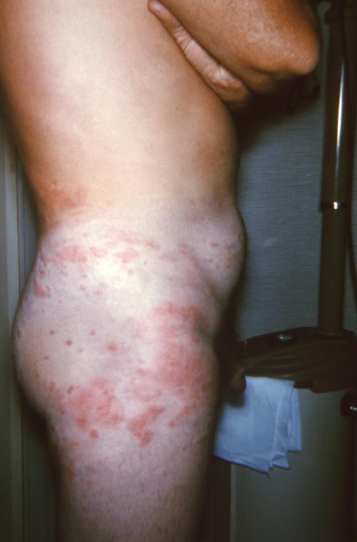 Haole Rot Details - Public Health Image Library(PHIL)