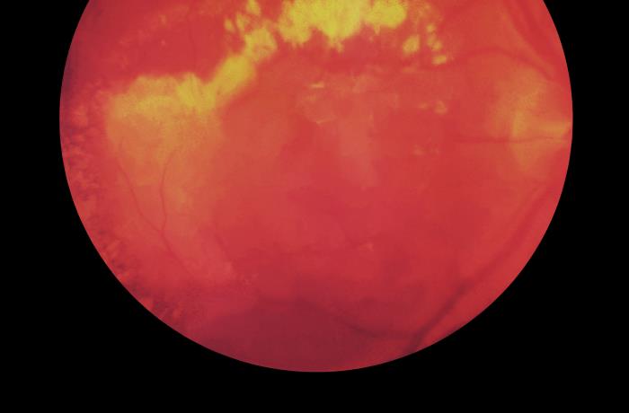 Details - Public Health Image Library(PHIL)