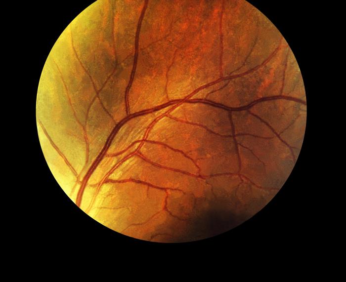 Details - Public Health Image Library(PHIL)