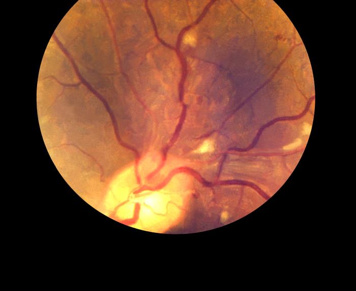 Details - Public Health Image Library(PHIL)