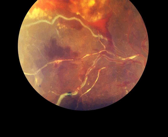 Details - Public Health Image Library(PHIL)
