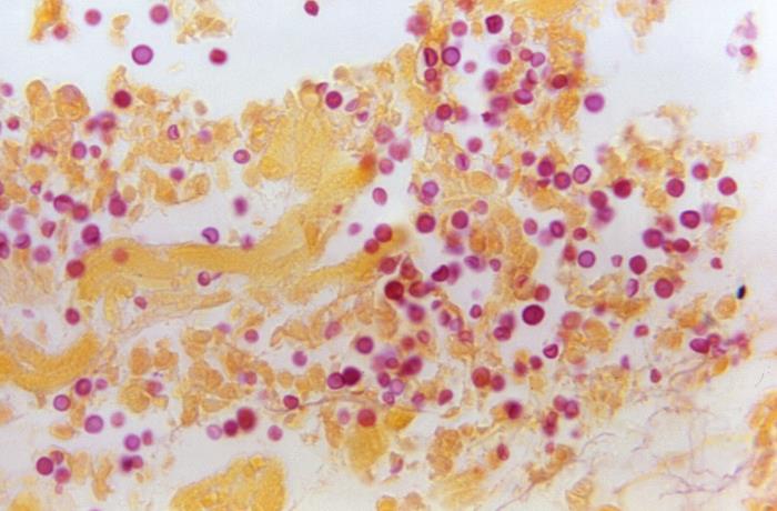 Details - Public Health Image Library(PHIL)
