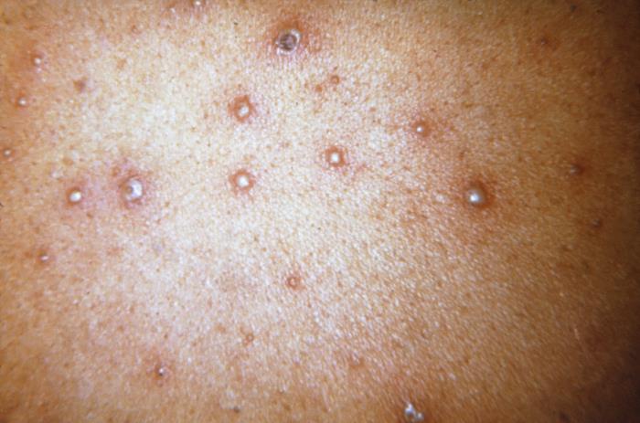 Haole Rot Details - Public Health Image Library(PHIL)