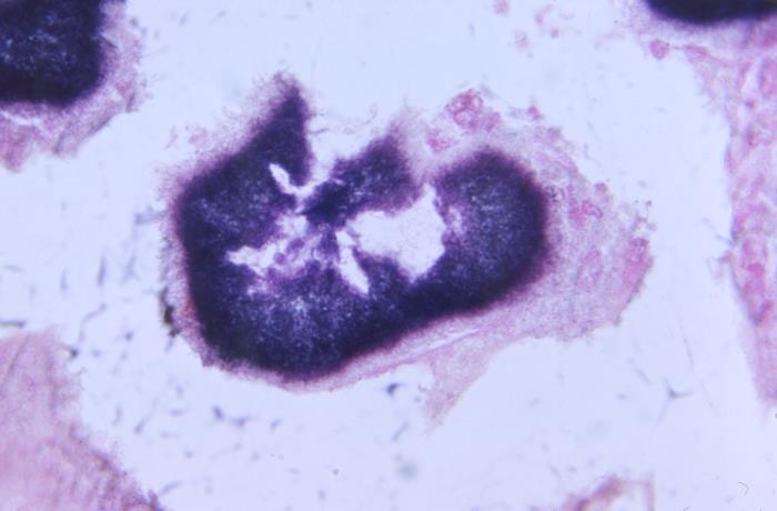 Details - Public Health Image Library(PHIL)