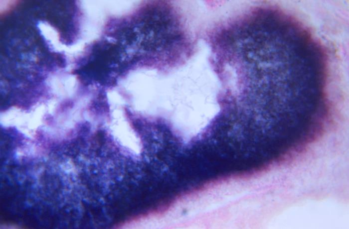 Details - Public Health Image Library(PHIL)