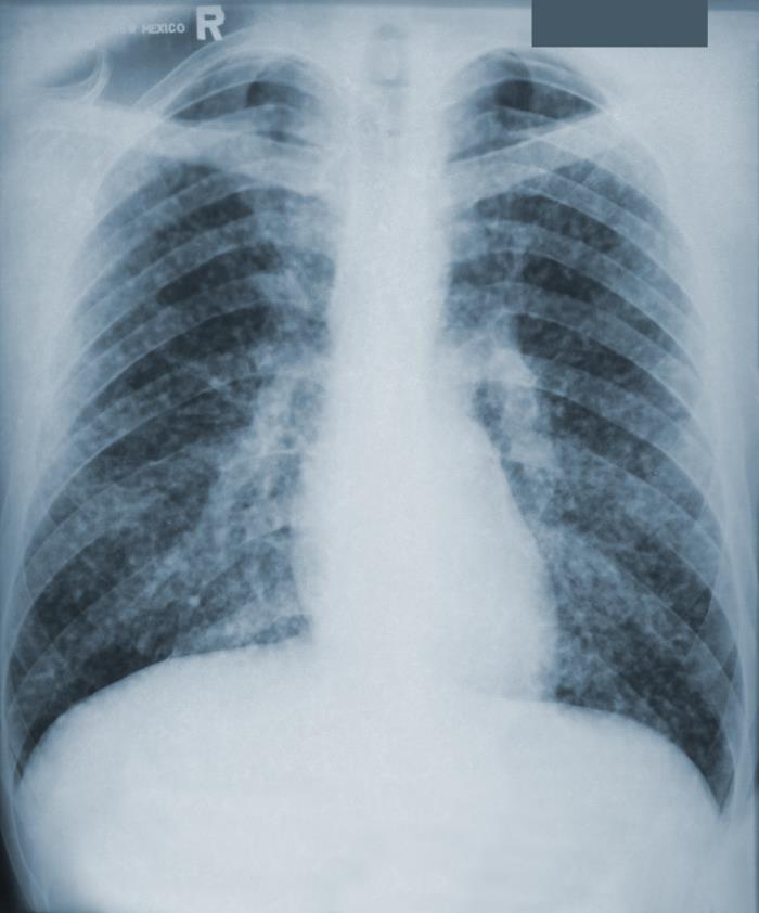 Details - Public Health Image Library(PHIL)