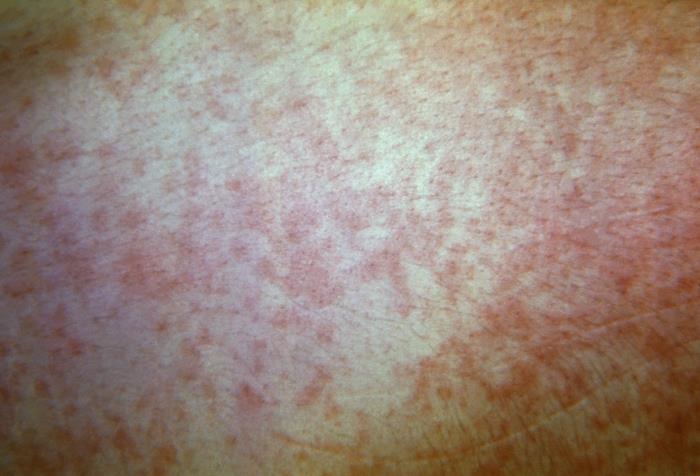 Haole Rot Details - Public Health Image Library(PHIL)