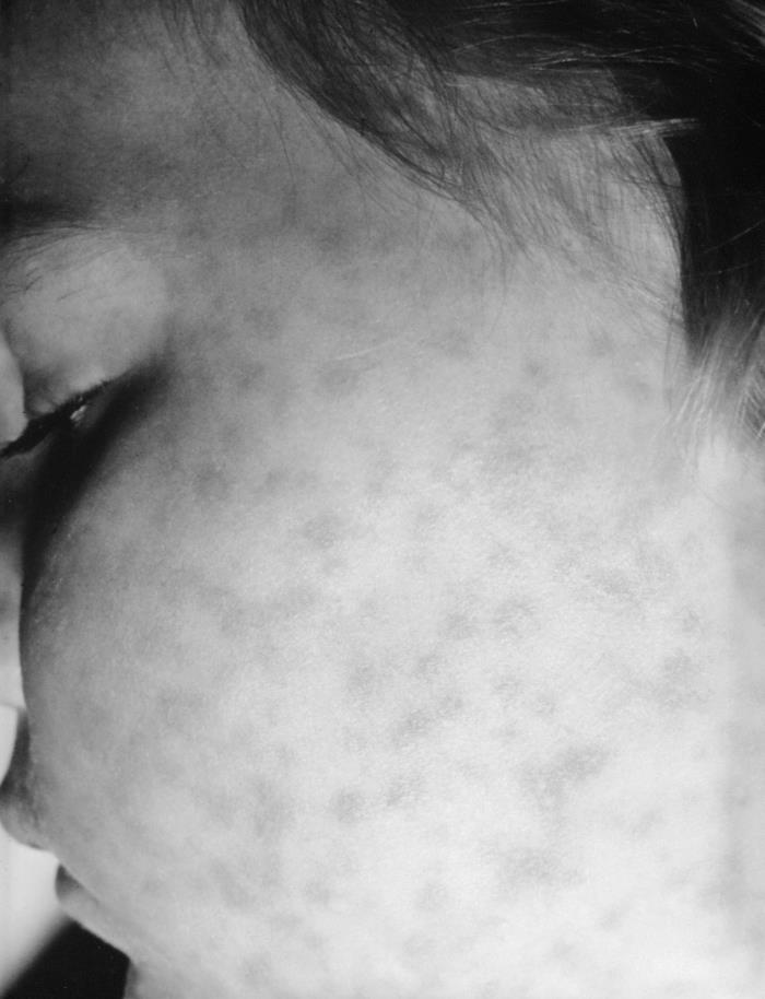 Details - Public Health Image Library(PHIL)