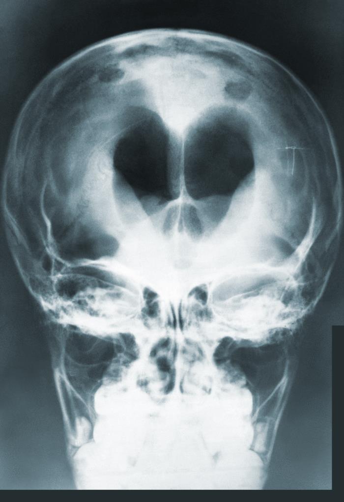 Pneumocranium Radiograph Details - Public Health Image Library(PHIL)