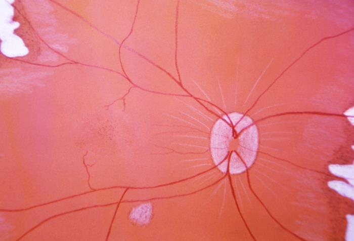 Details - Public Health Image Library(PHIL)