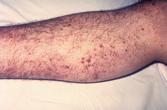 Details - Public Health Image Library(PHIL)