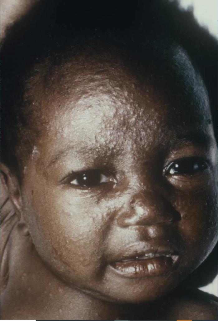 Smallpox In Kids Details - Public Health Image Library(PHIL)