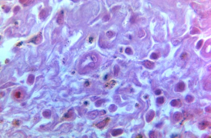 Microscopic view of Sézary cells in an H&E-stained skin biopsy, showing characteristic cerebriform nuclei