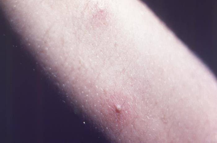 Details - Public Health Image Library(PHIL)