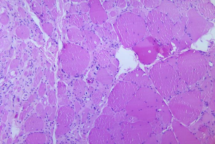 Details - Public Health Image Library(PHIL)