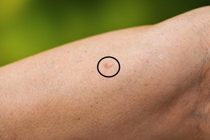 Pequena reação avermelhada provocada por uma picada de mosquito no braço