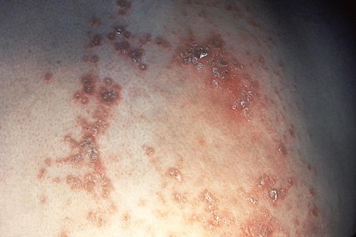 Haole Rot Details - Public Health Image Library(PHIL)
