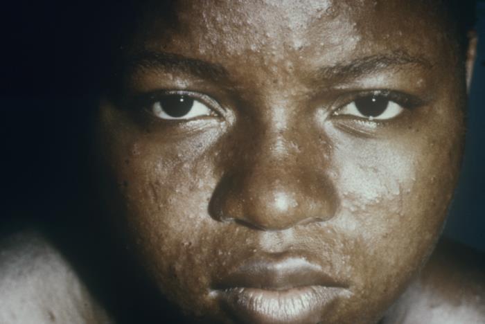 Details - Public Health Image Library(PHIL)