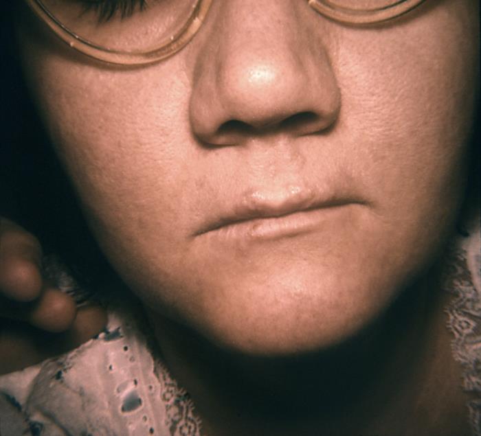 Herpes simplex lesions (cold sores) around the mouth, CDC public domain image