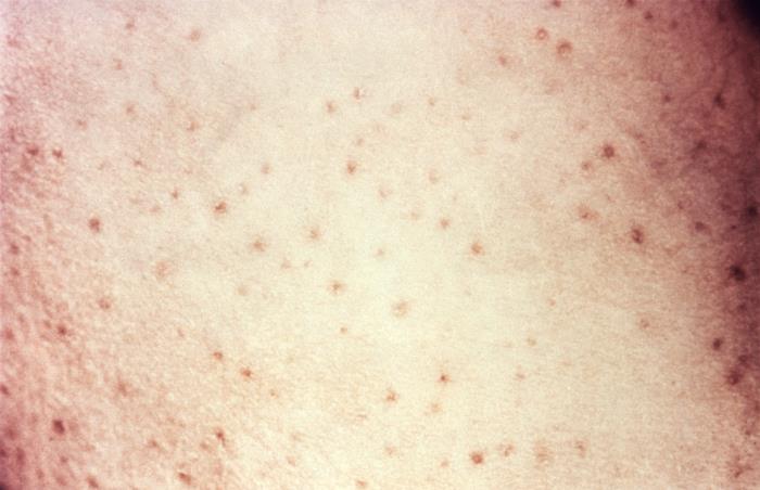 Petechiae