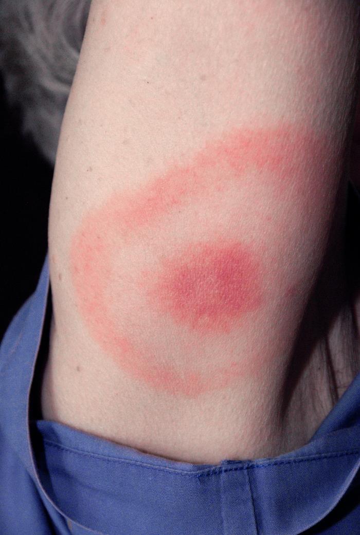 Classic bull's-eye erythema migrans rash on the upper arm of a lighter-skinned patient